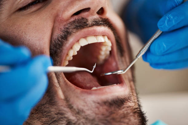 Best Root Canal Emergency Dentist  in Lofall, WA